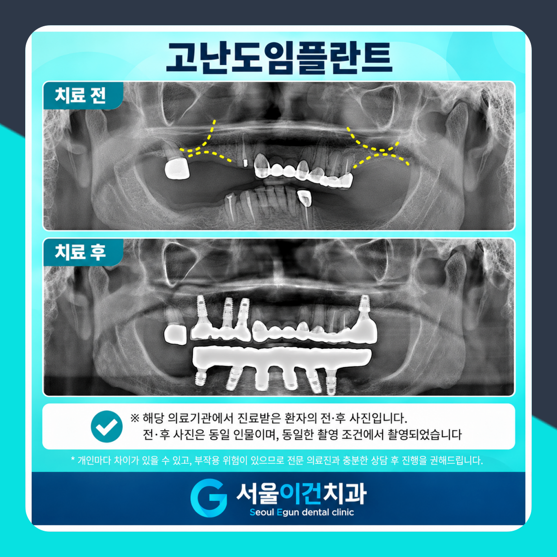뼈가 부족하다고 들으셨다면 — 상악동 거상술 이야기 서울이건치과