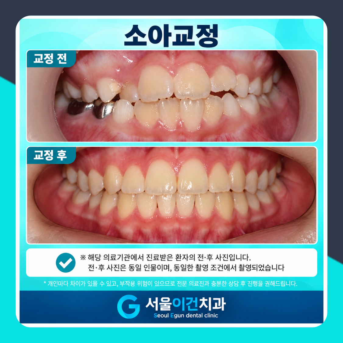 소아교정 시작 시기, 몇 살에 확인해야 할까요 서울이건치과