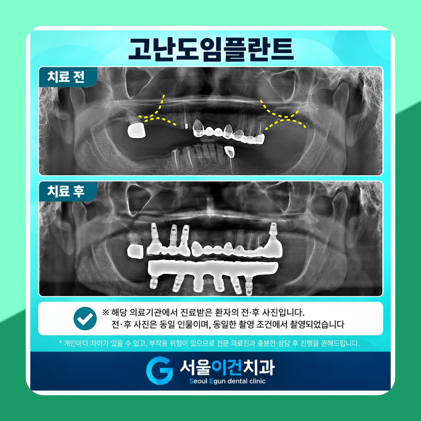 치과 의자에 앉는 게 유독 힘든 분들께 서울이건치과