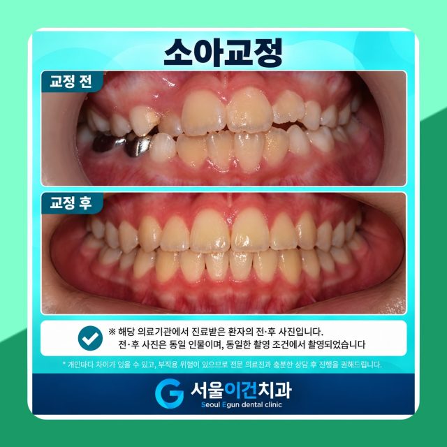 수원치과 – 소아 교정은 어떻게? 서울이건치과